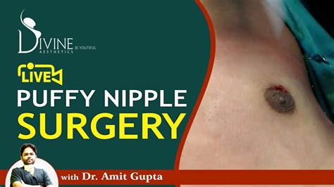 Live Puffy Nipple Surgery Youtube