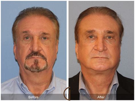 Facelift For Men Newport Beach Ca Dr Kevin Sadati Plastic Surgery