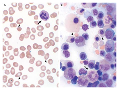 Homo Sapiens Diseases Alterations In Red Blood Cells Rbcs