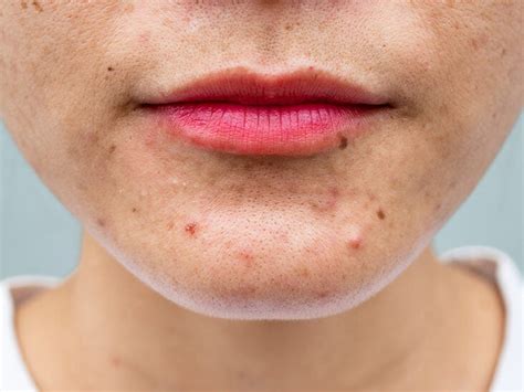 Puberty And Acne How A Good Skincare Routine Can Help