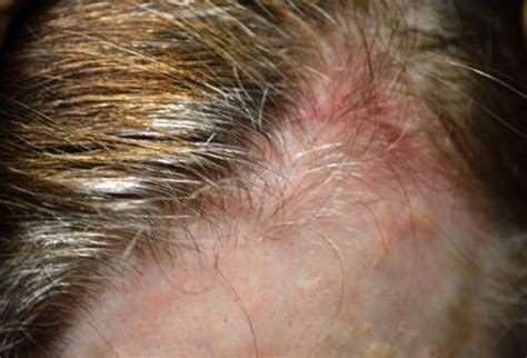 Shingles On Scalp Symptoms Pictures Contagious No Rash With