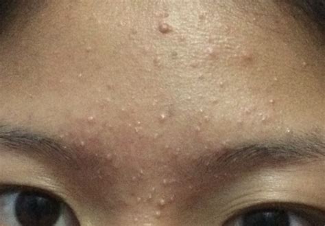 How To Get Rid Of Whiteheads On Forehead General Acne Discussion