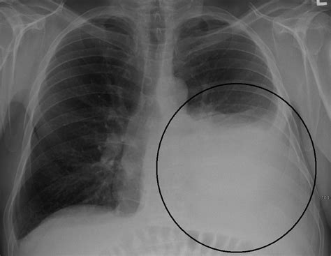 Understanding Icd 10 Pleural Effusion Causes Symptoms And Diagnosis