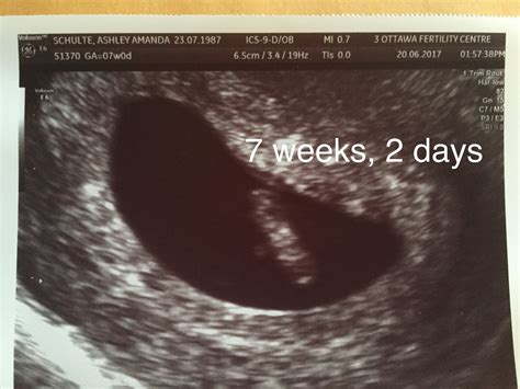 6 Weeks 2 Days Pregnant Ultrasound Hiccups Pregnancy