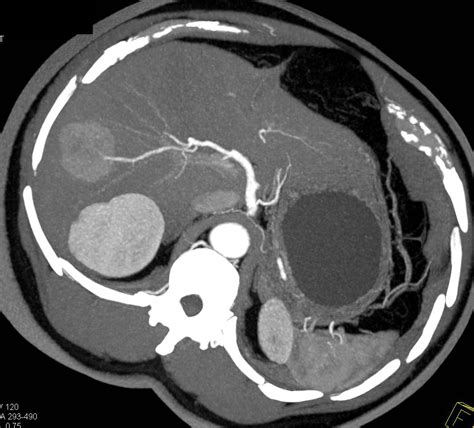 Focal Nodular Hyperplasia Fnh Liver Case Studies Ctisus Ct Scanning