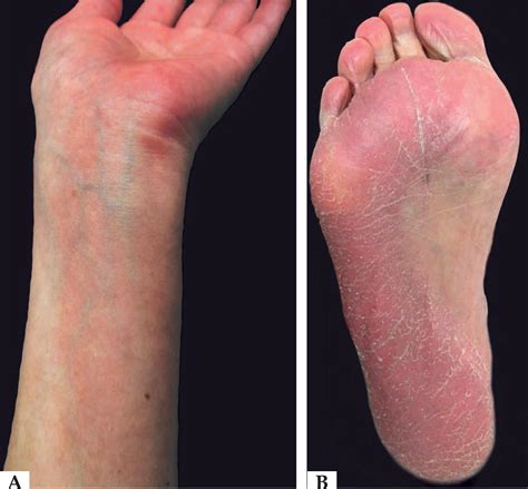 Scielo Brasil Grade Iii Hand Foot Skin Reaction Induced By