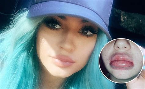 Kylie Jenner Lip Challenge Success Famous Person