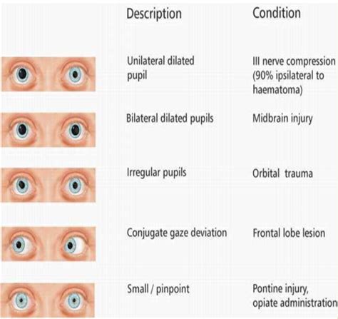 Causes Of Unequal Pupil Size Noredoffice