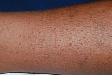 Dermatology Lichen Nitidus