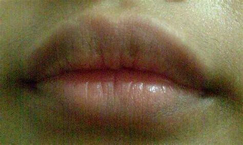 Lip Discoloration Pictures Causes Treatment Remedies 2018