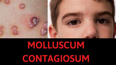Molluscum Contagiosum What Is Molluscum Contagiosum Symptoms Signs