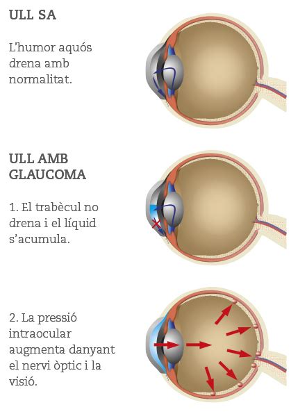 Glaucoma Clinica Oftalmologica Rubi