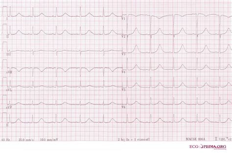 Long Qt Syndrome Electrocardiogram Wikidoc