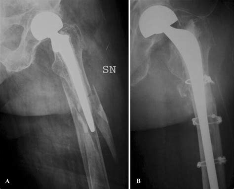 Past And Present Of The Use Of Cerclage Wires In Orthopedics Springerlink