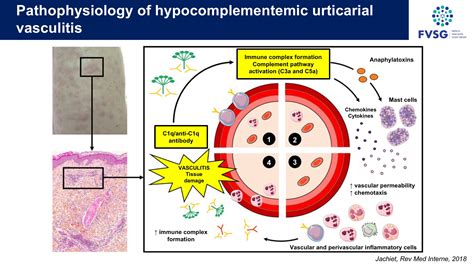 Pathophysiology Of Hypocomplementemic Urticarial Vasculitis C1qanti