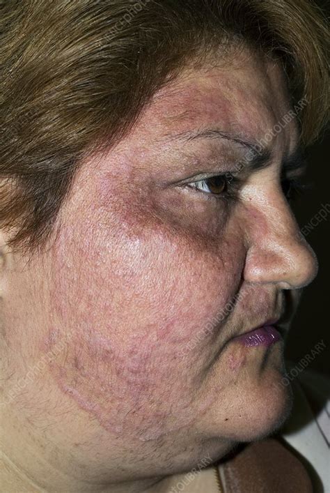 Tinea Fungal Infection On The Face Stock Image C0103370 Science
