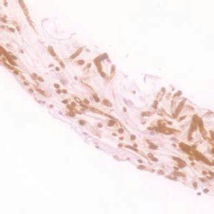 Habitualmente aparece en pacientes con algún tipo de inmunodeficiencia (diabéticos, pacientes con sida o a tratamiento con fármacos inmunosupresores). Cultivo en agar dextrosa de Sabouraud que desarolló ...