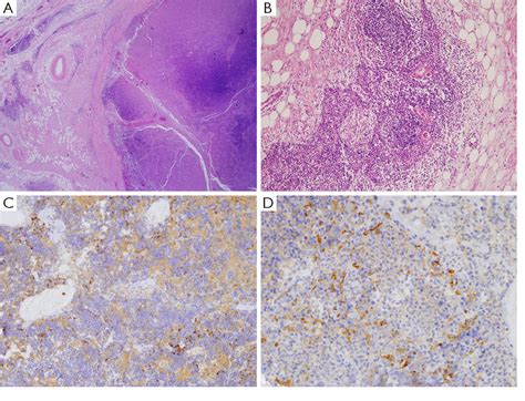 Figure From Complete Excision Of Acute Necrotic Regression Of Thymoma