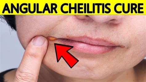 Cracked Lip Corners The Deficiency Youre Probably Missing — Eating