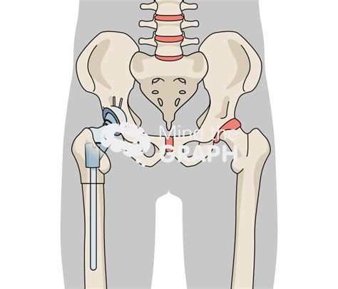 Subtrochanteric Osteotomy Tha Body