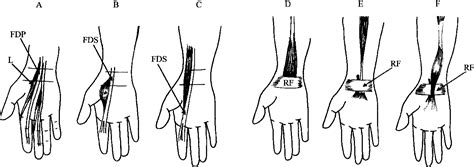 Pdf Median And Ulnar Nerve Compression At The Wrist Caused By
