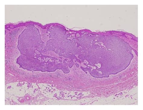 A Clinical Appearance Of Basal Cell Carcinomas In The Right Axillae