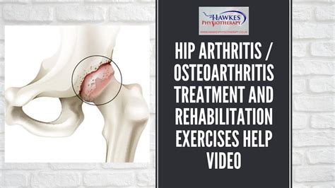 Hip Arthritis Osteoarthritis Treatment And Rehabilitation Exercises