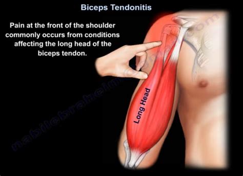 Biceps Tendonitis OrthopaedicPrinciples Com