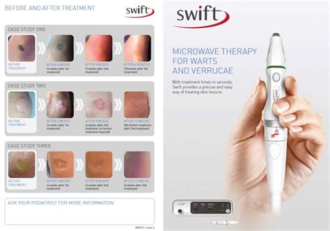 Swift® Microwave Therapy Treatment For Verruca And Wart