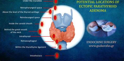 Ectopic Parathyroid Adenoma Clinical Importance Of Embryology