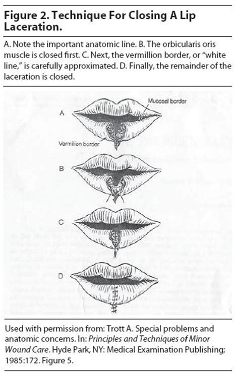Lip Lacerations Qanda Pemblog