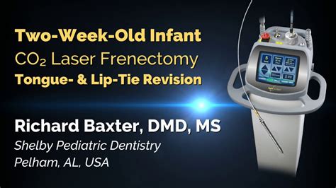 Infant Co2 Laser Frenectomy Tongue And Lip Tie Release Richard Baxter Dmd Youtube