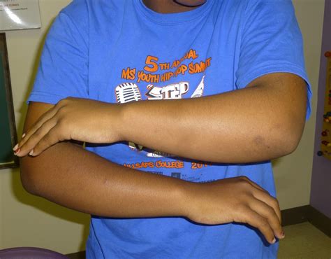 Madelungs Deformity Congenital Hand And Arm Differences