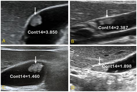 Ultrasound Images Of Gallbladder Cholesterol Polyps Ab And