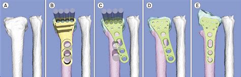 Figure 1 From Surgical Technique Of Corrective Osteotomy For Malunited