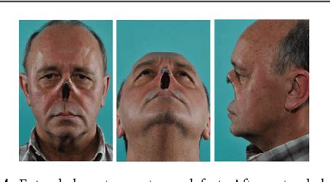 Figure 4 From Total Nasal Reconstruction After Nasectomy In A Case Of