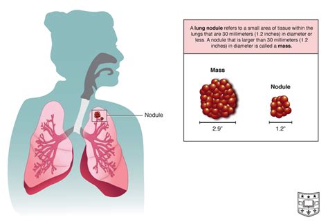 Ask The Doctors Lung Nodules Department Of Surgery Washington