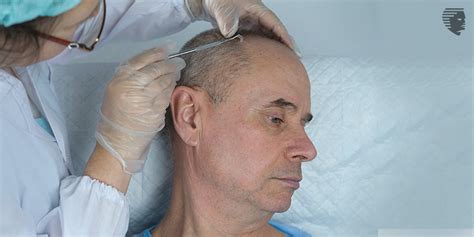 Busting The Myths That Hair Transplant Causes Cancer Ahs India