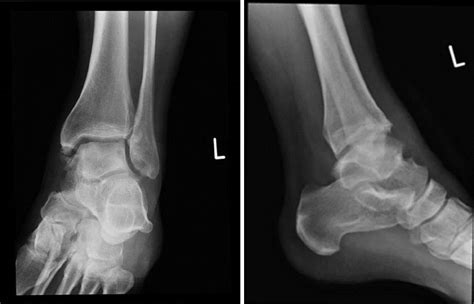 E Plain Radiograph Of Ankle Ap And Lateral Showing Osteochondral Lesion