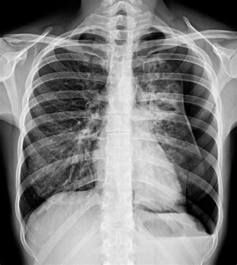 Chest X Ray Left Pneumothorax Download Scientific Diagram