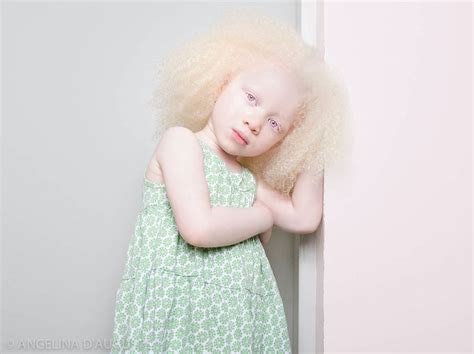 Unique Beauty Of Albino People
