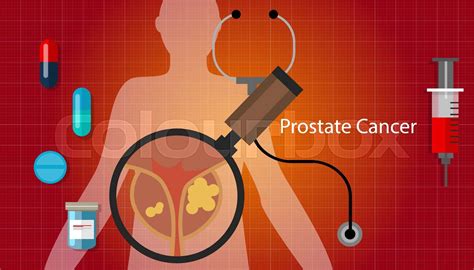 Prostate Cancer Health Medical Illustration Medication Cure Stock Vector Colourbox