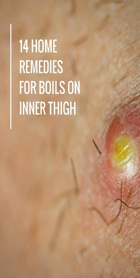 17 Best Homemade Remedies For Boils Images Remedies Home Remedy For
