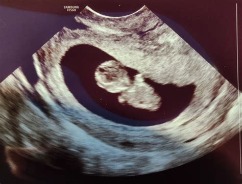 7 Week Miscarriage Predaddit