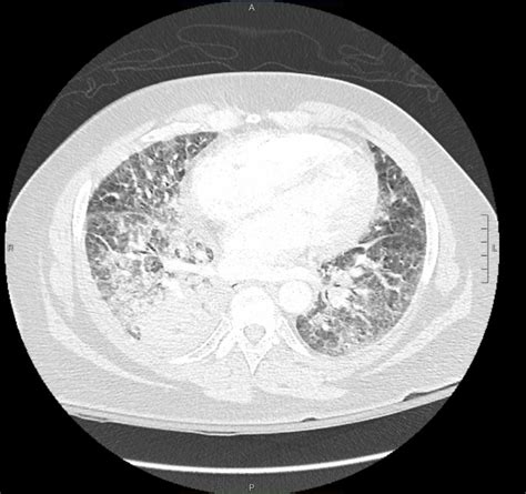 A Case Of Pulmonary Lymphangitic Carcinomatosis As The Initial