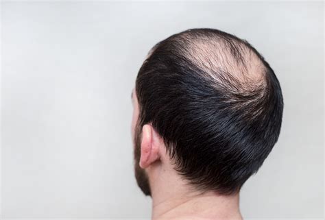 Using a proper brush, apply full. How to Prevent Hair Loss in Men: The Ultimate Guide | Hold ...