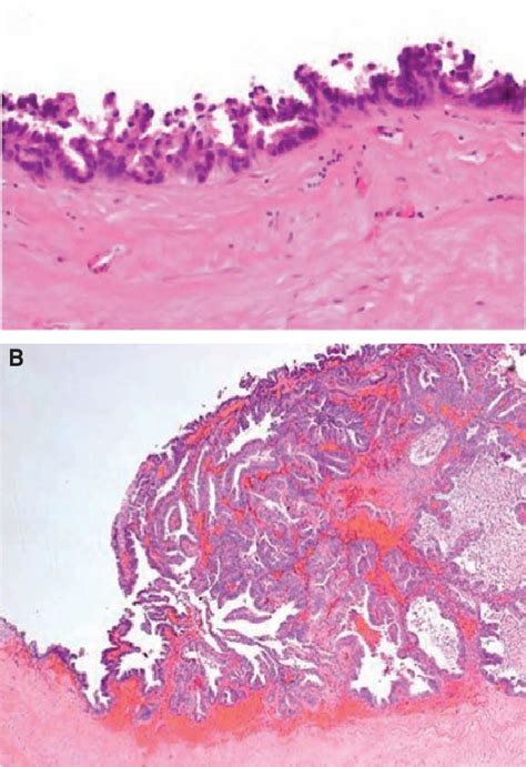 Figure 2 From Management Of A Ruptured Mucinous Mesenteric Cyst With