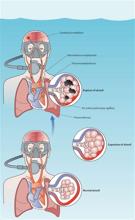 Decompression Illness The Lancet