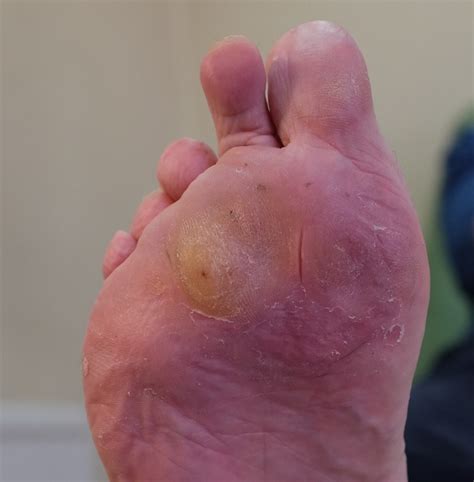 How Arthritis Can Affect Our Feet Feel Your Feet