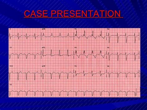 Ecg Rbbb With Lafb